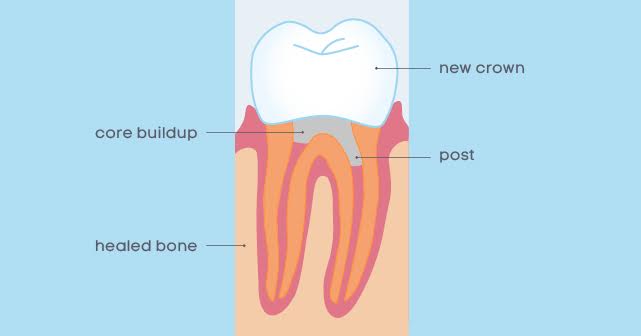 Post and core tooth replacement method